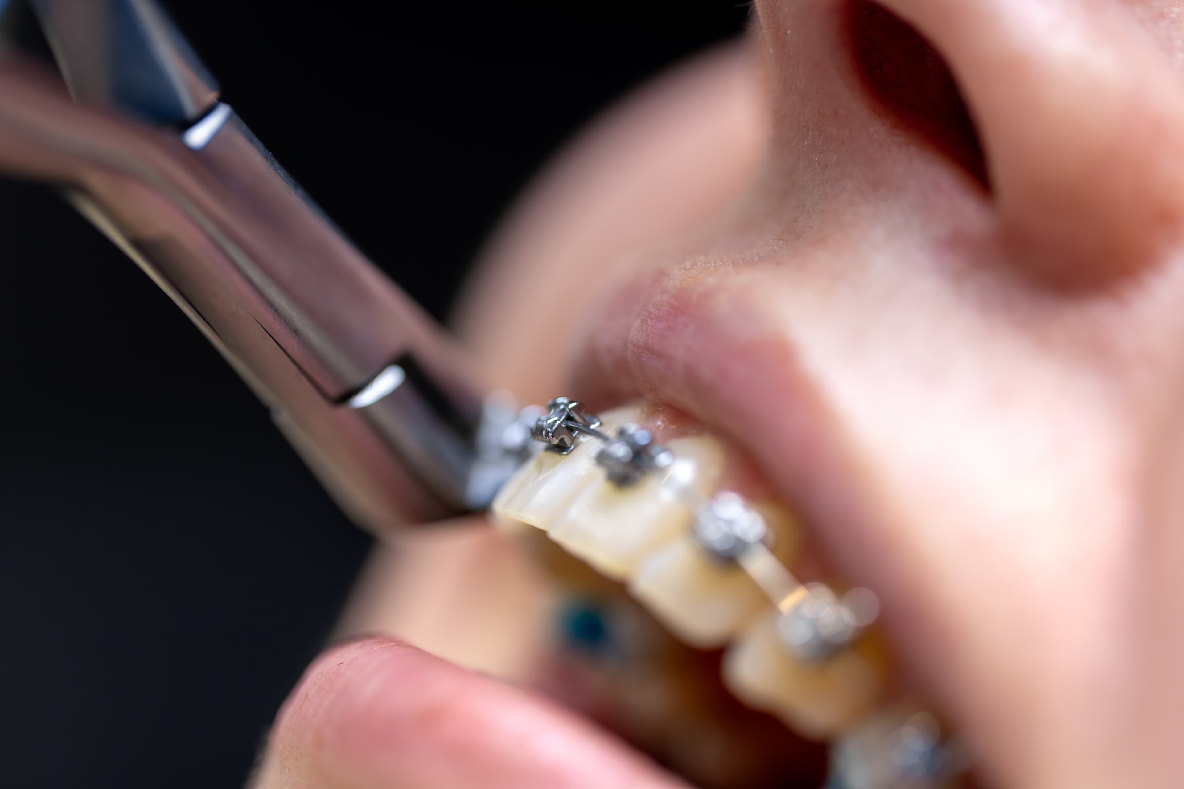Braces & Clear Aligners