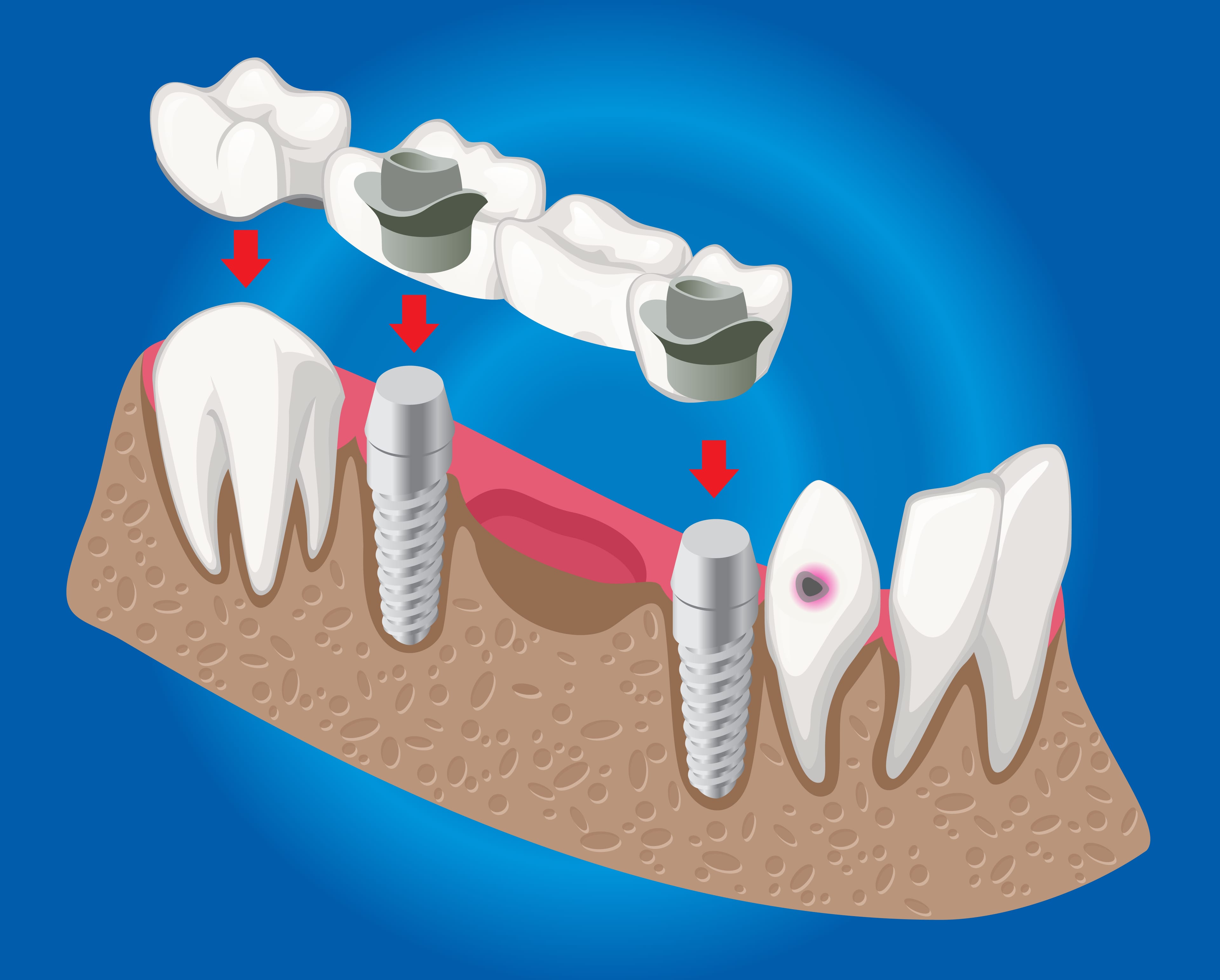 Dental Implants vs. Bridges vs. Dentures: What's Right for You?