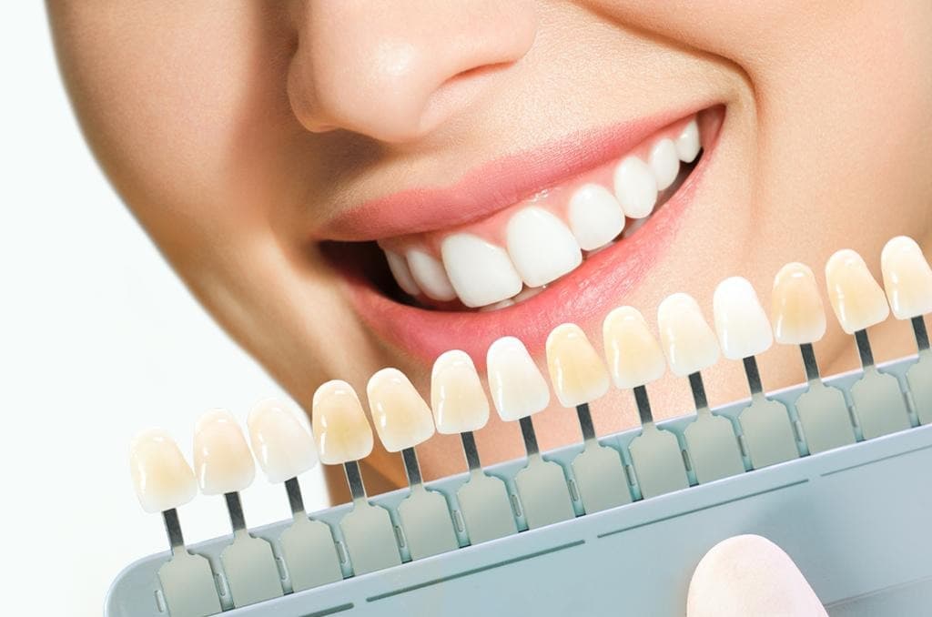 Dental Veneers